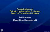 Complications of Ectopic Ureteroceles & Ureters Seen In ......Pathologic Key to Bladder Neck Dysfunction (Outlet) Causing Obstruction Pathologic Alterations •Over distension bladder
