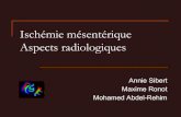 Ischémie mésentérique Aspects radiologiqueshepatoweb.com/DES/exposes/DES02_2013_CORCOS/SIBERT.pdf · Post-op: traction-torsion Artère et veine Pas de résection ! Reconnaître: