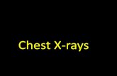 Chest X-Raysksumsc.com/download_center/5th/medicine lectures/5) Chest...Chest X ray •is the most commonly performed diagnostic x-ray examination. Images •heart, lungs, airways,