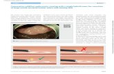 Consecutive cold/hot underwater snaring with a single hybrid snare … · ventional cold snare resection was attempted but was not possible because of the quantity of tissue trapped