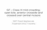 GT – Class III mild crowding, open bite, anterior ...