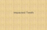 Impacted Teeth - Subharti Dental College