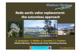 Redo aortic valve replacement: the sutureless approach