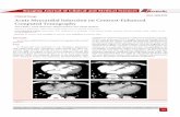 Acute Myocardial Infarction on Contrast-Enhanced Computed ...