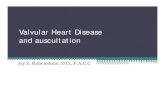 Valvular Heart Disease and auscultation - sjhg. Stenosis Etiology Pathology • Rheumatic Fever- 99% • Other Congenital Carcinoid Lupus Amyloid Infective Endocarditis Mucopolysaccharide
