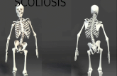 Scoliosis (Spine Disorder)